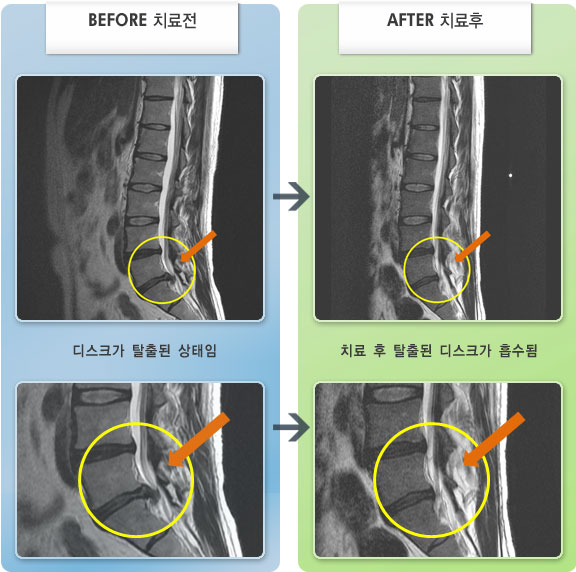 자생한방병원 치료사례 MRI로 보는 치료결과-우측 다리 통증, 다리 저림