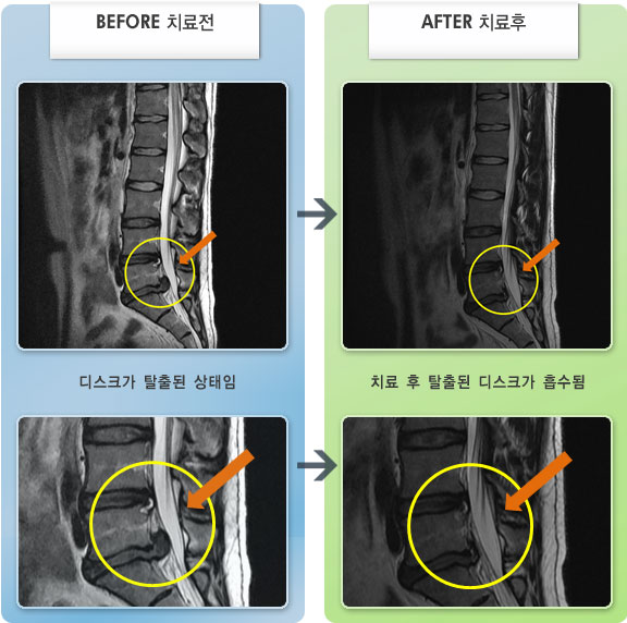자생한방병원 치료사례 MRI로 보는 치료결과-오른쪽 엉치에서 발바닥까지 저림