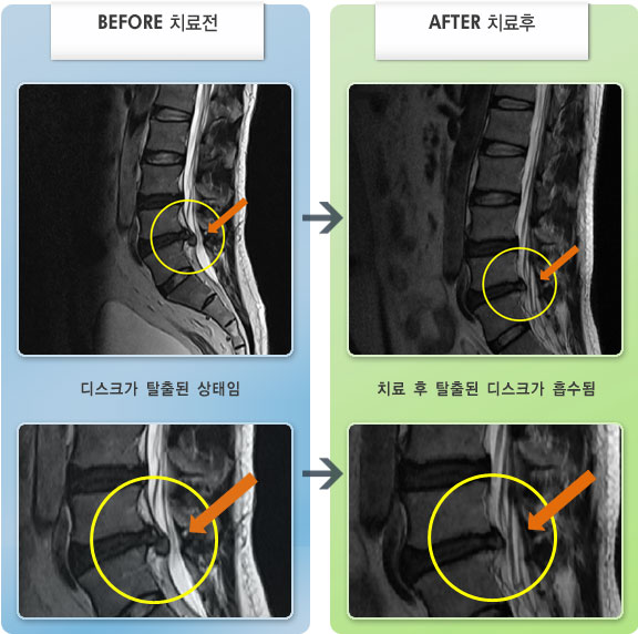 자생한방병원 치료사례 MRI로 보는 치료결과-왼쪽 허리와 엉덩이, 다리 통증