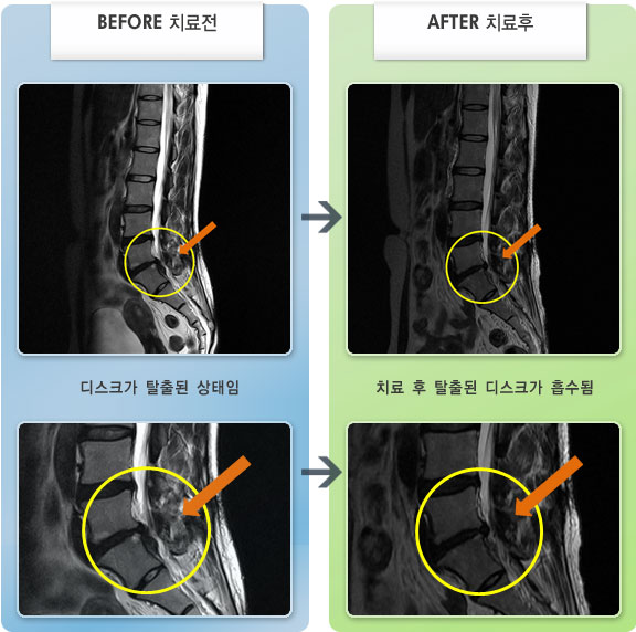 자생한방병원 치료사례 MRI로 보는 치료결과-허리 통증과 왼쪽 다리 저림 및 감각 둔한 느낌이 심함