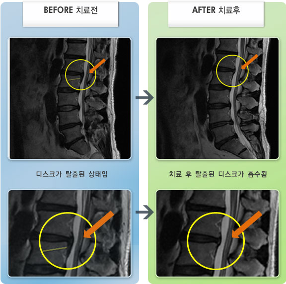 자생한방병원 치료사례 MRI로 보는 치료결과-허리 구부렸다 폈다할 때,  일어날 때 통증 증가