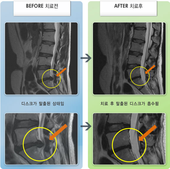자생한방병원 치료사례 MRI로 보는 치료결과-오른쪽 엉덩이 통증있고 다리 외측으로 저리고 뒷꿈치까지 아픔