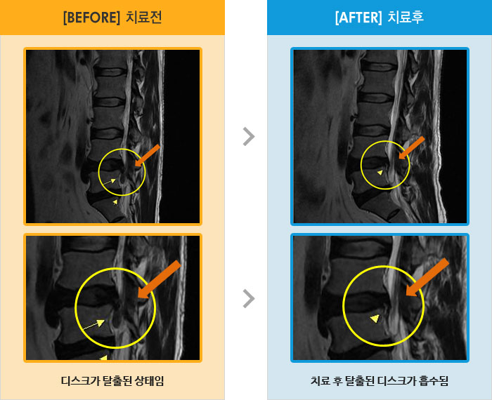 자생한방병원 치료사례 MRI로 보는 치료결과-허리와 오른쪽 엉치, 대퇴부, 종아리 통증