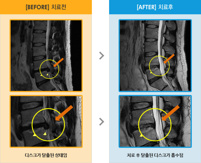 자생한방병원 치료사례 MRI로 보는 치료결과-50m정도 걸으면 왼쪽 엉치에서 종아리까지 통증