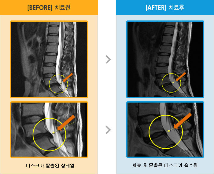 자생한방병원 치료사례 MRI로 보는 치료결과-허리 통증과 왼쪽 다리 저림감 및 당김감, 종아리 떨림