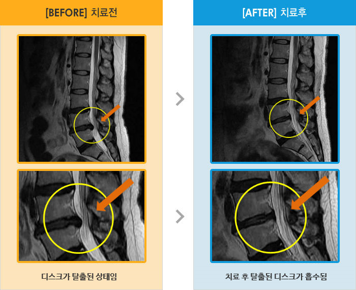 자생한방병원 치료사례 MRI로 보는 치료결과-저녁에 자려고 다리 뻗으면 좌측 엉치부터 종아리까지 저린감