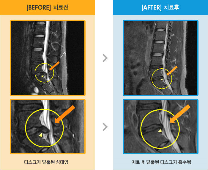 자생한방병원 치료사례 MRI로 보는 치료결과-허리 통증 및 오른쪽 다리가 저리고 당기는 통증이 심함