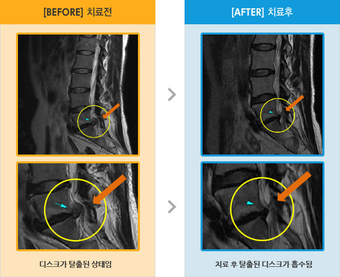 자생한방병원 치료사례 MRI로 보는 치료결과-왼쪽 허리 및 엉덩이 통증