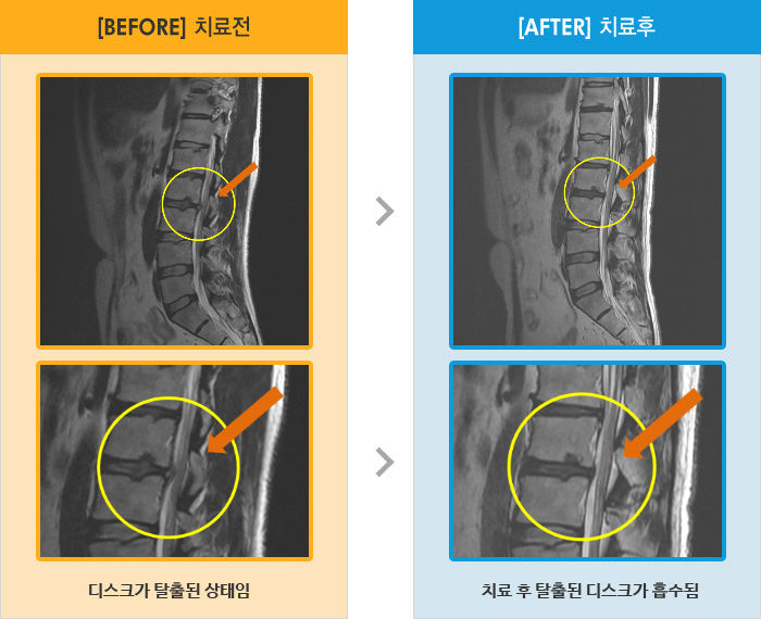 자생한방병원 치료사례 MRI로 보는 치료결과-오른쪽 허리 통증과 엉덩이 저림