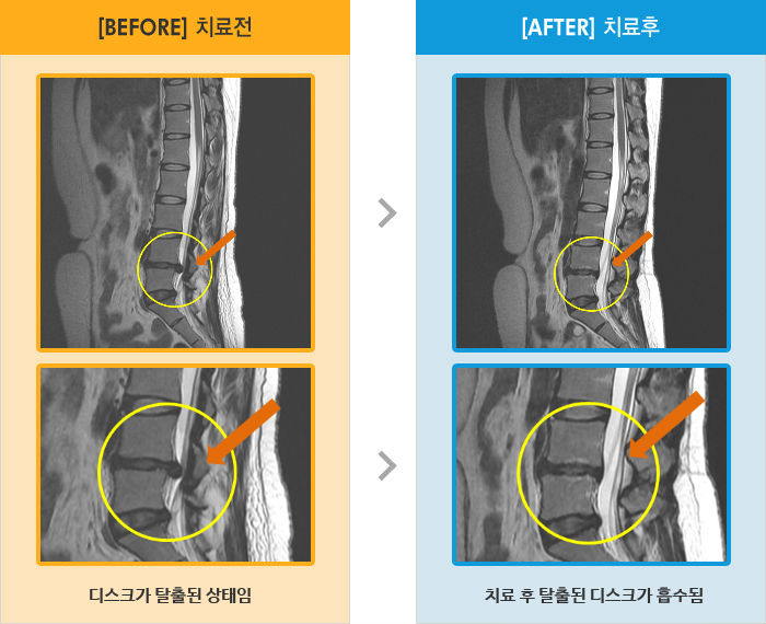 자생한방병원 치료사례 MRI로 보는 치료결과-허리 주위로 심한 통증과 왼쪽 엉치, 다리 저림