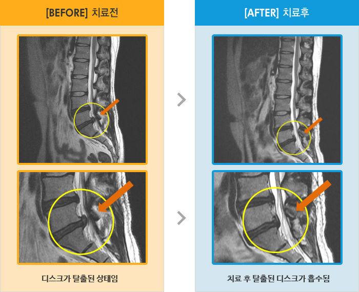 자생한방병원 치료사례 MRI로 보는 치료결과-허리,엉덩이 부위 심한 통증과 발 저림