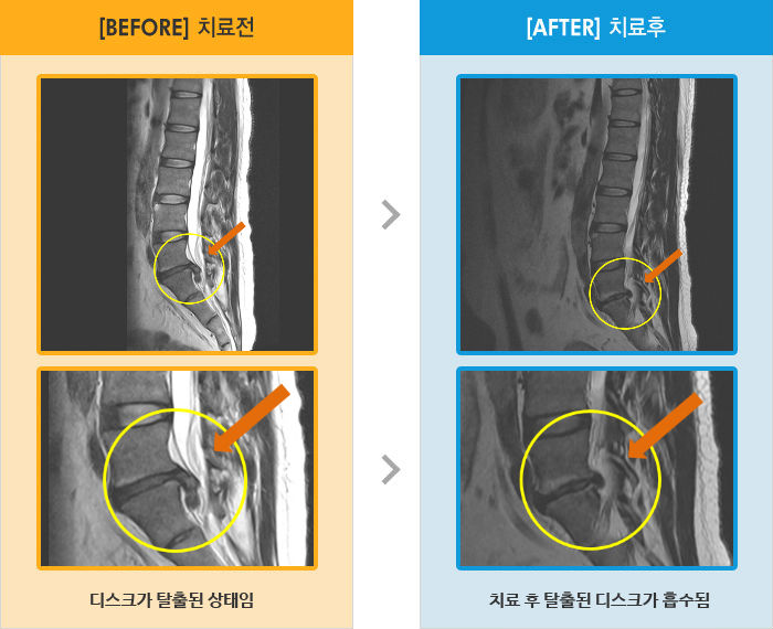 자생한방병원 치료사례 MRI로 보는 치료결과-좌측 골반에서 다리까지 통증과 저림