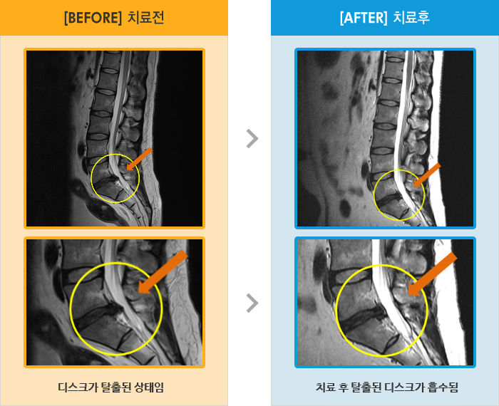 자생한방병원 치료사례 MRI로 보는 치료결과-우측 골반 및 꼬리뼈 통증이 있고 다리 감각장애