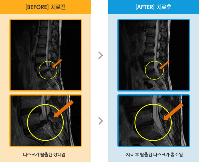자생한방병원 치료사례 MRI로 보는 치료결과-허리와 왼쪽 엉덩이 통증과 허벅지에서 종아리 뒤로 저림