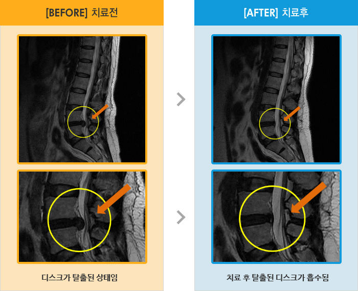 자생한방병원 치료사례 MRI로 보는 치료결과-허리 뻐근감과 왼쪽 엉치 통증이 있었고 특히 아킬레스건쪽으로 통증