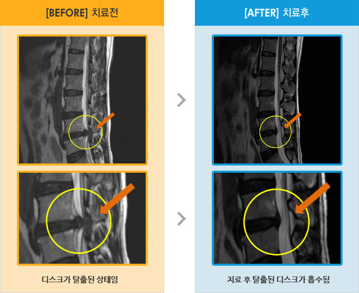 자생한방병원 치료사례 MRI로 보는 치료결과-왼쪽 허리 통증과 왼쪽 다리 전체 저림