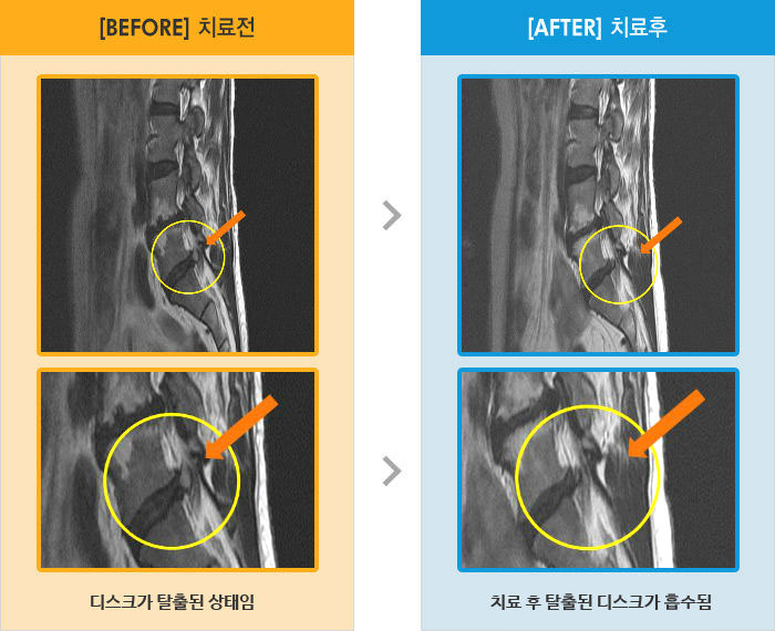 자생한방병원 치료사례 MRI로 보는 치료결과-종아리 근육 뭉친 느낌과 발가락 쥐나는 증상