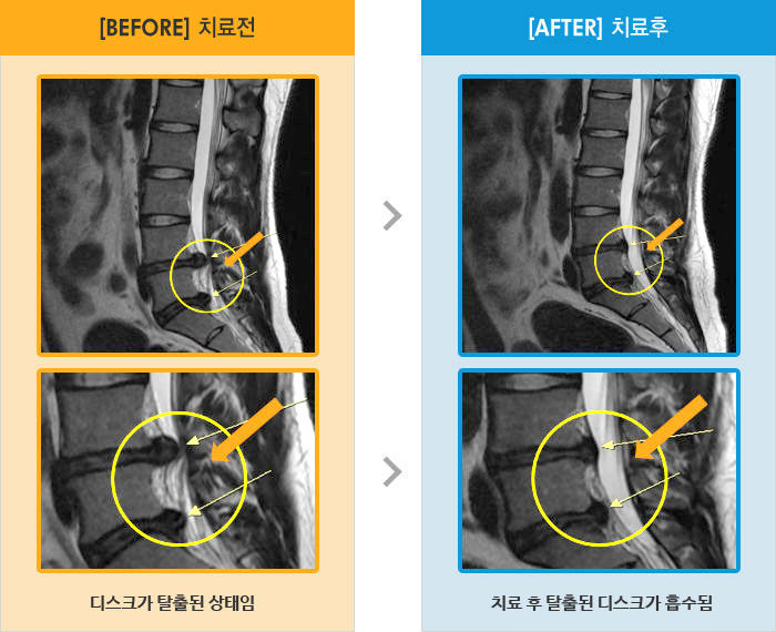 자생한방병원 치료사례 MRI로 보는 치료결과-오른쪽 엉치에서 오금까지 저리고 당기는 통증이 심해 보행이 어려움