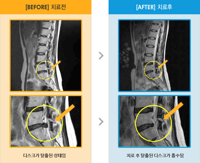 자생한방병원 치료사례 MRI로 보는 치료결과-오른쪽 엉덩이에서 다리 전체 통증과 저림