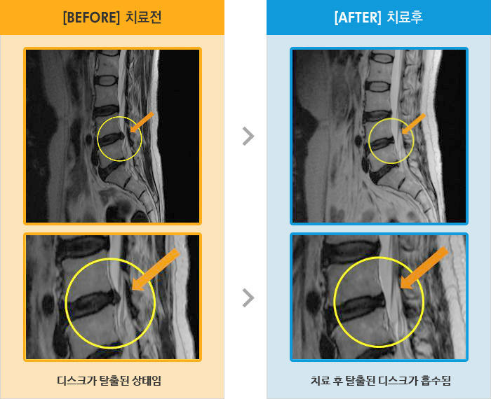 자생한방병원 치료사례 MRI로 보는 치료결과-허리통증과 다리 저림으로 기상시, 숙일 때, 특히 오전에 증상이 많아 일상생활이 불가능