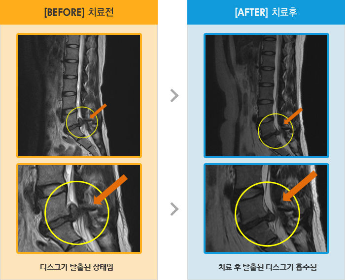 자생한방병원 치료사례 MRI로 보는 치료결과-오른쪽 발바닥과 발저림 증상으로 걸을 때 마다 극심한 통증