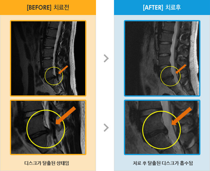 자생한방병원 치료사례 MRI로 보는 치료결과-오른쪽 엉덩이부터 다리 뒤로 저리고 당김이 심함