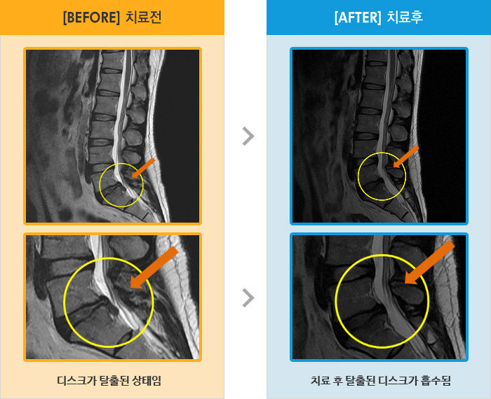 자생한방병원 치료사례 MRI로 보는 치료결과-오래 앉아있다 일어날 때 허리 뻐근감이 있고 오른쪽 다리 저리고 당김