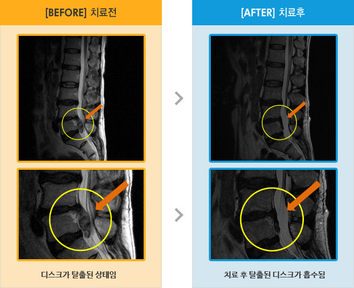 자생한방병원 치료사례 MRI로 보는 치료결과-양쪽 엉덩이, 종아리 통증