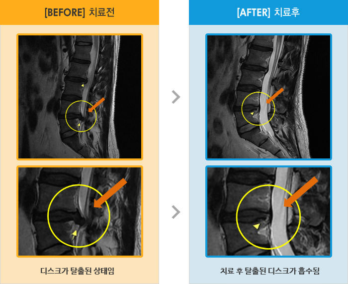 자생한방병원 치료사례 MRI로 보는 치료결과-허리와 오른쪽 골반 및 다리 통증