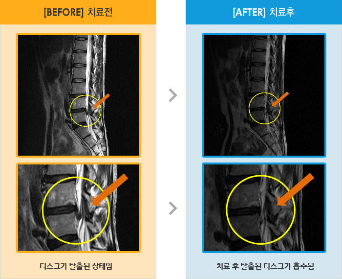 자생한방병원 치료사례 MRI로 보는 치료결과-오른쪽 허리에서 다리 통증