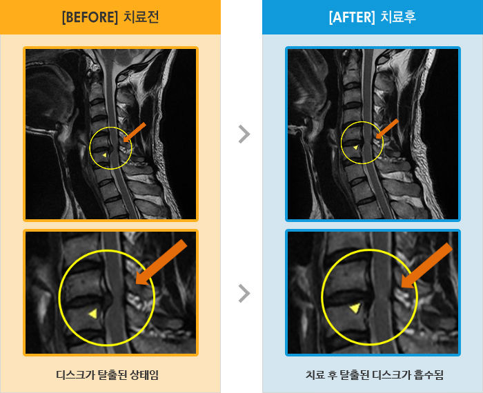 자생한방병원 치료사례 MRI로 보는 치료결과-목 통증으로 목을 뒤로 젖힐 때 힘듬