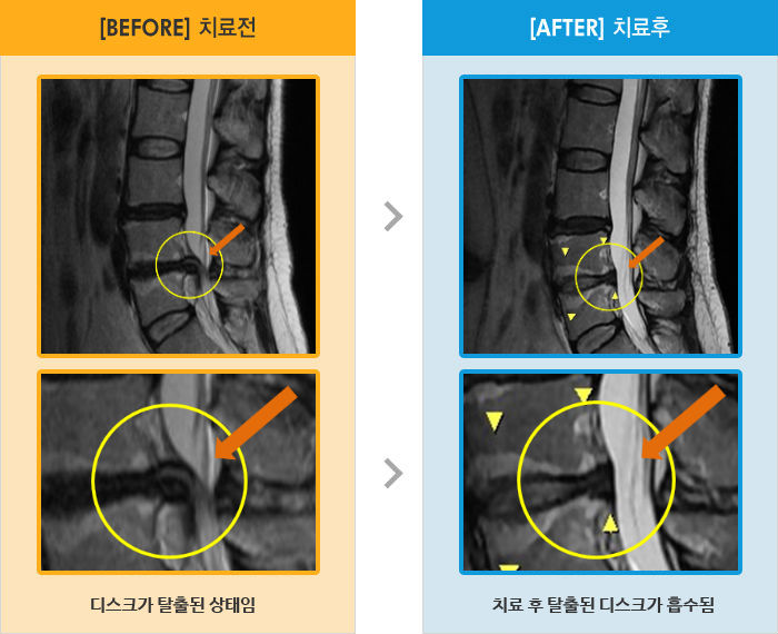 자생한방병원 치료사례 MRI로 보는 치료결과-왼쪽 엉치에서 발끝까지 통증이 허리 통증보다 심함