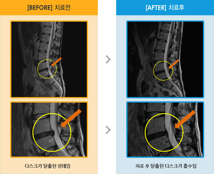 자생한방병원 치료사례 MRI로 보는 치료결과-허리와 왼쪽 다리 통증