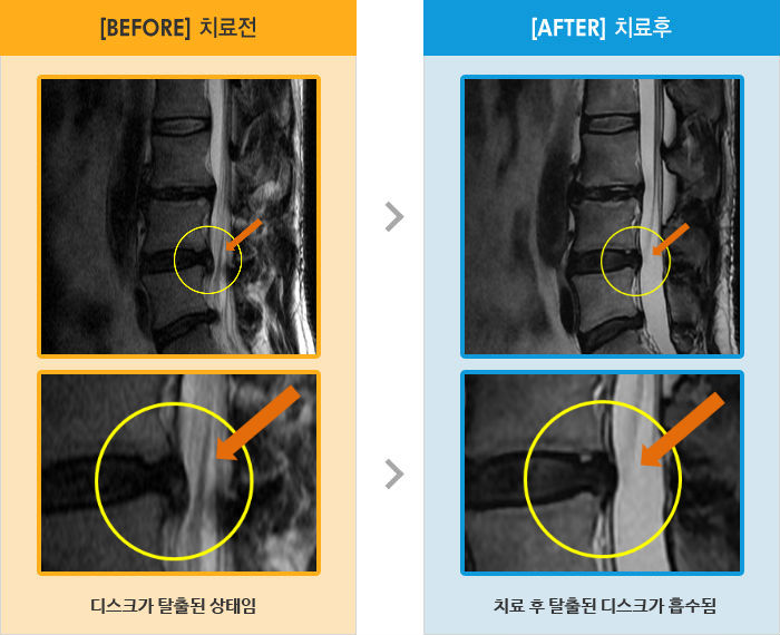 자생한방병원 치료사례 MRI로 보는 치료결과-바로 누워있거나 옆으로 돌아누울 때 허리, 엉치 통증
