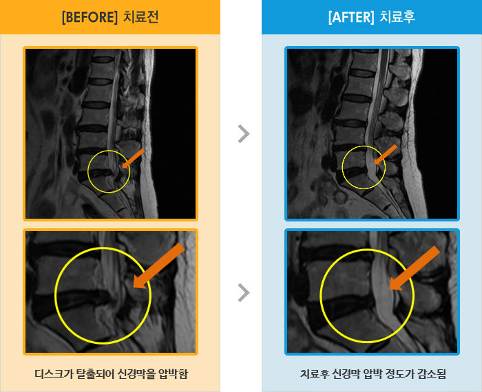 자생한방병원 치료사례 MRI로 보는 치료결과-허리 펼때, 목 젖힐 때, 누운상태에서 조차 다리를 펴면 당기고 쑤시는 통증