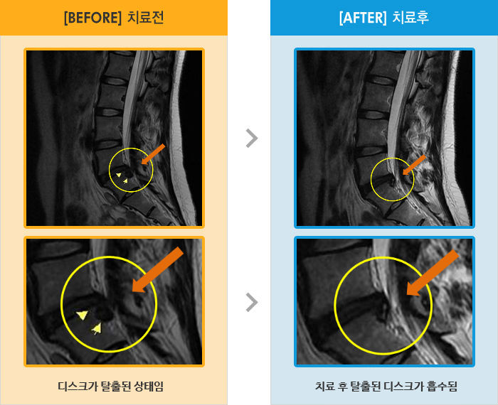 자생한방병원 치료사례 MRI로 보는 치료결과-왼쪽 엉덩이 및 다리 통증