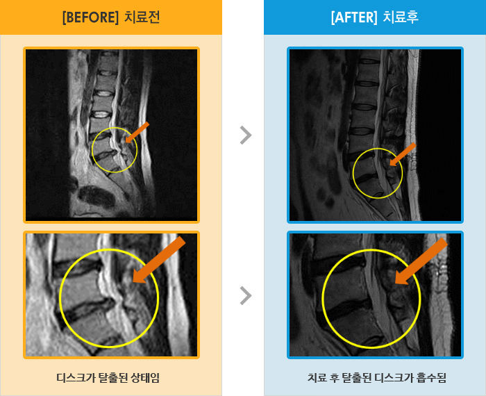 자생한방병원 치료사례 MRI로 보는 치료결과-왼쪽 다리가 당기고 찌르는 듯한 통증