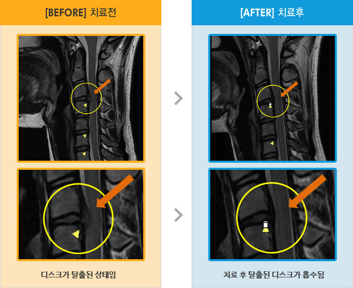 자생한방병원 치료사례 MRI로 보는 치료결과-뒷목 가운데에서 양쪽 옆으로 통증이 있어 움직일때마다, 걸을 때 통증을 느낌