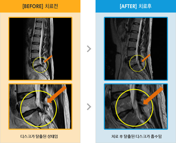 자생한방병원 치료사례 MRI로 보는 치료결과-허리와 왼쪽 다리 통증으로 앉는 자세가 여러움