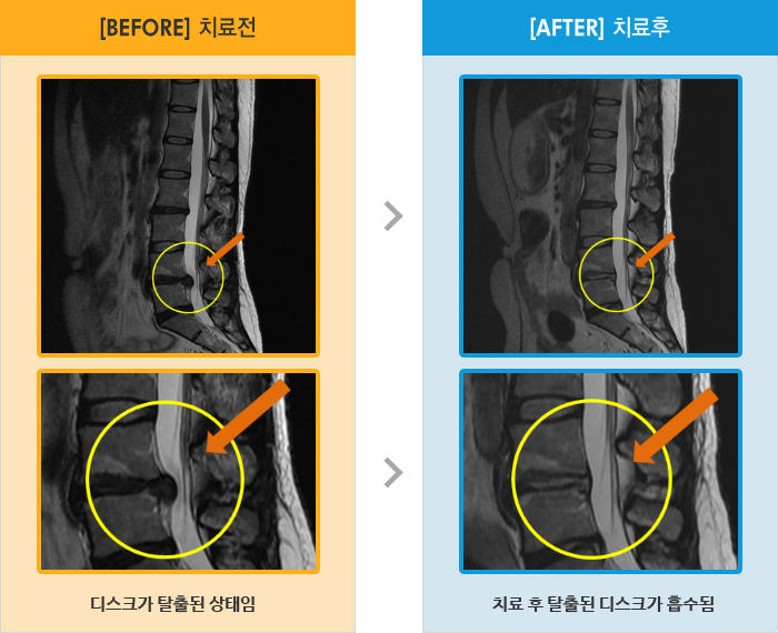 자생한방병원 치료사례 MRI로 보는 치료결과-허리와 왼쪽 골반 통증, 기상시 통증을 느낌