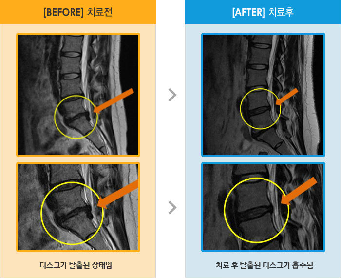 자생한방병원 치료사례 MRI로 보는 치료결과-상하부 양측 통증