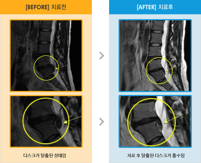 자생한방병원 치료사례 MRI로 보는 치료결과-허리 숙이거나 젖힐 때 통증, 걷거나 밤에 통증