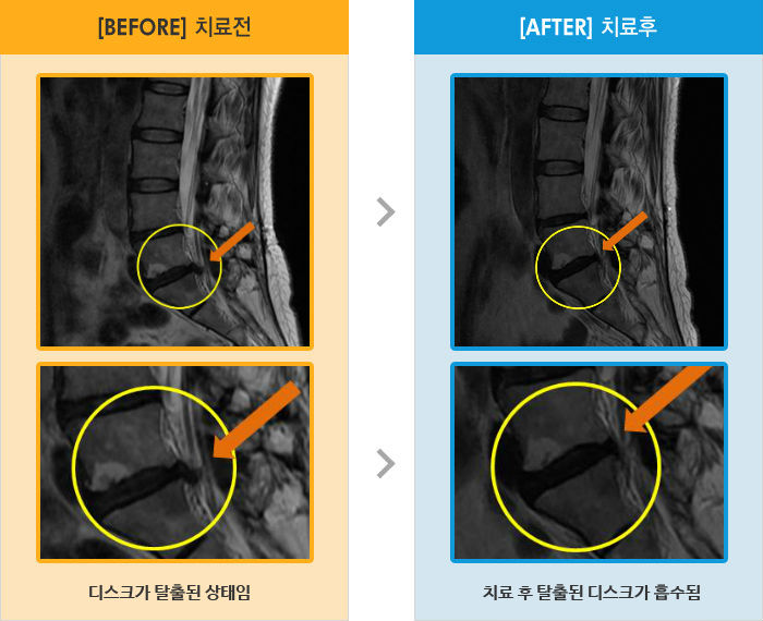 자생한방병원 치료사례 MRI로 보는 치료결과-골반 왼쪽 통증과 다리 저림 증상