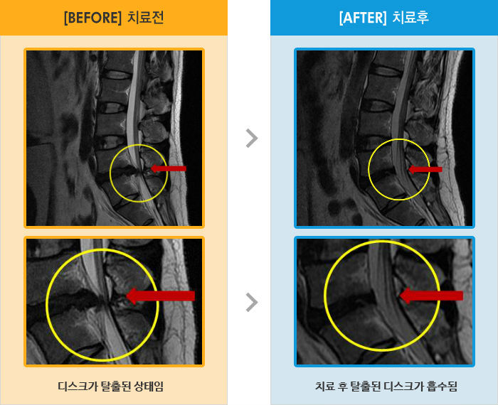 자생한방병원 치료사례 MRI로 보는 치료결과-허리 펼때 서 있을때 허리통증, 우측 엉치에서 엉덩이까지 당기고 발가락 저림