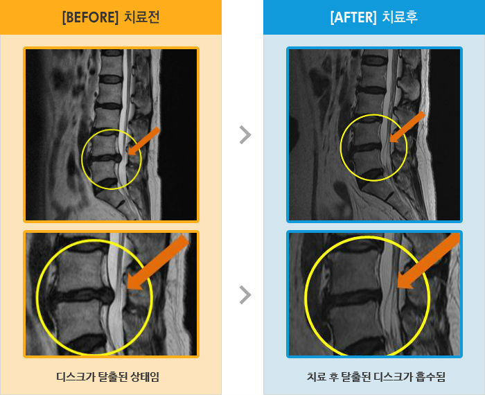 자생한방병원 치료사례 MRI로 보는 치료결과-허리통증과 우측 엉덩이 통증 및 발등 저림