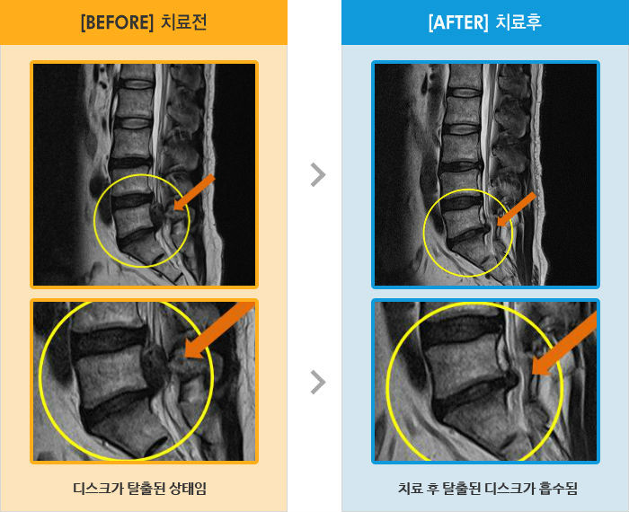 자생한방병원 치료사례 MRI로 보는 치료결과-왼쪽 다리 통증, 감각저하