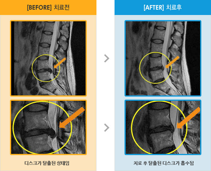 자생한방병원 치료사례 MRI로 보는 치료결과-양쪽 다리 전체적으로 저림, 기상시 통증