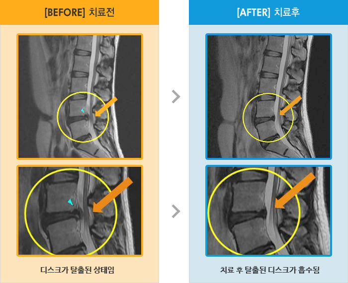 자생한방병원 치료사례 MRI로 보는 치료결과-골반과 오른쪽 다리 통증으로 빨리 걷지 못함