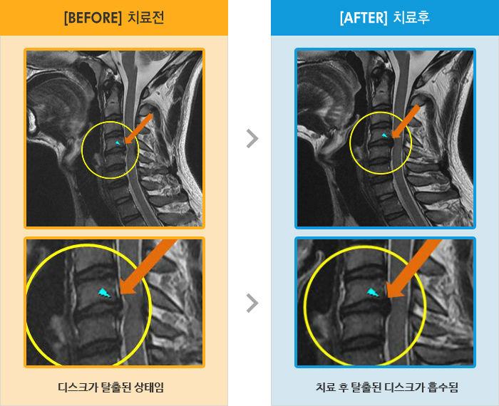자생한방병원 치료사례 MRI로 보는 치료결과-목뒤가 뻐근하고 등쪽으로 통증