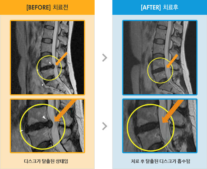 자생한방병원 치료사례 MRI로 보는 치료결과-허리 통증과 좌측 다리 저림